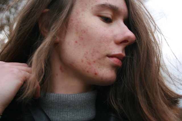 Homeopathy Treatment for Acne