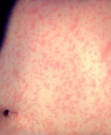 The measles rash - though acute measles is rare today - the vaccine is live and so attenuated measles symptoms may be seen